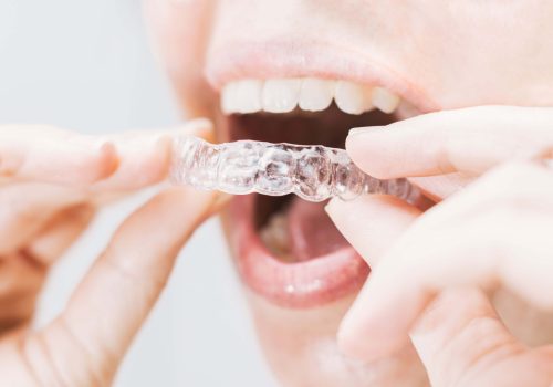 mouth-with-transparent-retainer-2023-01-09-22-38-26-utc-min